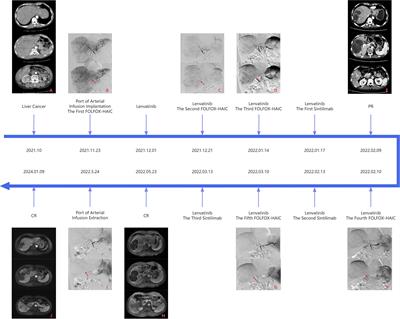 Hepatic arterial infusion chemotherapy with implantable arterial access port for advanced-stage hepatocellular carcinoma: a case report